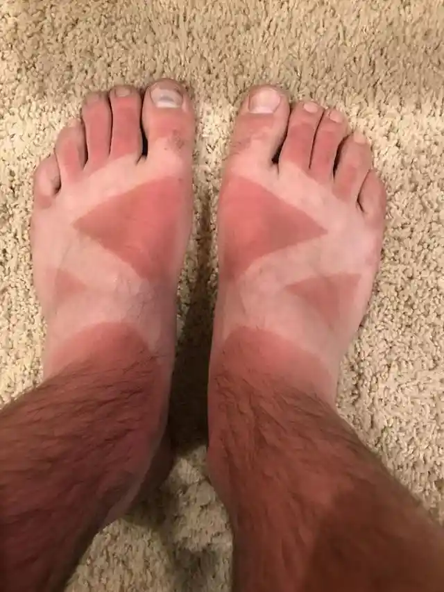 40+ Sunburn Pictures That Makes Us Happy Winter Is Coming